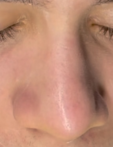 After the extraction treatment