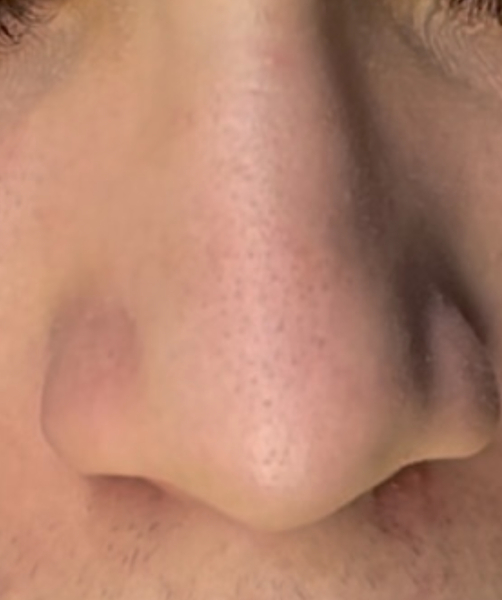 Before the extraction treatment