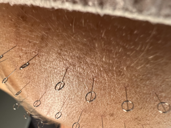 Online Facial Intradermal Needling Course