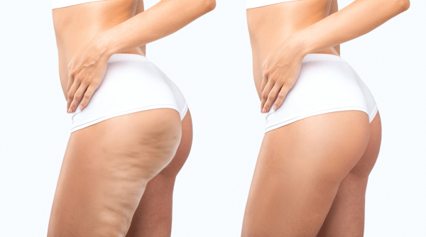 Cellulite Analysis & Treatment Online Course